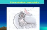 Ulcera duodenal hemorrágica Sutura directa de la Arteria gastroduodenal