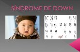 Descubrimiento: John Langdon Haydon Down y Jérôme Lejeune. Alteración genética de los cromosomas.