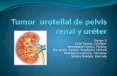 Tumor  urotelial de pelvis renal y uréter