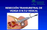 RESECCION TRANSURETRAL DE VEGIJA O.R.T.U. VESICAL