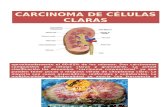 Carcinoma de Células Claras