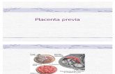06 Placenta Previa
