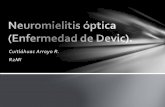 Neuromielitis óptica (enfermedad de devic)..