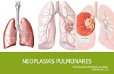 Neoplasias pulmonares