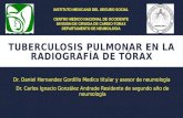 Tuberculosis pulmonar en la radiograf­a de t³rax