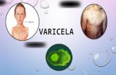 Presentación de varicela