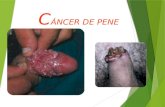 Cancer de pene