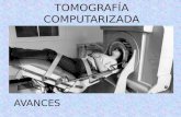 Tomografía Computarizada