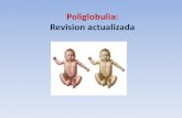 Poliglobulia: Revision · PDF fileLa poliglobulia se asocia a: •RN Post término •PEG-RCIU •GEG •Gemelar con Transfusión feto-fetal. •HMD •Anomalías cromosómicas: T21
