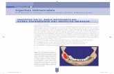 Capítulo 6 Injertos intraorales - media.axon.esmedia.axon.es/pdf/95400_2.pdf · La toma de injertos óseos de la rama mandibular es, en la actualidad, la técnica in - traoral de