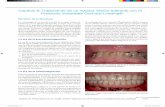 Capítulo 8: Tratamiento de un maxilar inferior edéntulo ... · PDF file174 Restauración de Implantes El protocolo Brånemark (Brånemark y otros 1977) para implantes dentales incluye: