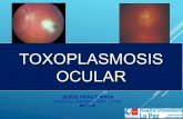 TOXOPLASMOSIS OCULAR - sociedado · PDF fileProtocolo diagnóstico Toxoplasmosis Diagnóstico toxoplasmosis ocular fundamentalmente clínico, basado en hallazgos funduscópicos característicos