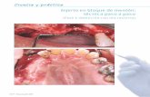 Ciencia y práctica - Maxillaris - Revista del sector dental · con más riesgo de lesión para las raíces de los ... cias significativas entre las distintas preparaciones de la