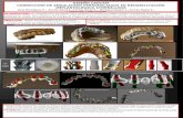 DISEÑO CADCAM CORRECCIÓN DE ANGULACIÓN …misiberica.es/wp-content/uploads/2016/10/2-premio-Protesis-Poster... · visualizaciÓn de las emergencias rectas de los tornillos en color