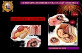 EMBARAZO ECTOPICO - educaperu.com.pe · •1.-endometrio puede ser engrosado mayor de 15mm,hiperecogenico llamado decidual que presenta la reaccion de a-s