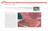 CasoClínicoIX - maxillaris.com · bre 2004, pág. 61), el liquen plano es una enfermedad crónica infla- matoria que afecta a la piel y/o a las mucosas y, especialmente, a la mucosa