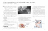Fracturas del cuello femoral: artroplastia - orthotrauma.esorthotrauma.es/assets/pdf/04-fracturas-femoral-artroplastia.pdf · ral, centrada en el trocánter mayor con la porción