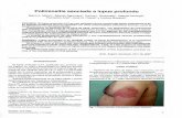 Polimiositis asociada a lupus profundo. Argent. Dermatol. 57 7-10, 2007.pdf · das a LP, entre ellas la dermatomiositis y la escleroder ... adinamia, disfagia progresiva a sólidos