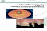 ImplantologíaMultidisciplinaria (Parte XXI) · 138 MaxillariS Noviembre 2006 cienciaypráctica Figs. 13 y 14. Para duplicar eel pperfil dde eemergencia, usamos una réplica del implante,