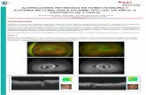  · 2018-12-18 · La disfunción retiniana progresiva y maculopatia estån descritos en la mayoria de los casos en los de inicio precoz. mientras que en los de inicio tardio, ocasionalmente.
