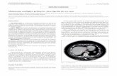 Melanoma esofágico primario: descripción de un casoscielo.isciii.es/pdf/diges/v108n10/es_notas_clinicas2.pdfde esófago (Fig. 2). Al microscopio la lesión estaba com-puesta por