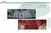 ImplantologíaMultidisciplinaria - maxillarisintervenido en el sector anterior, en dientes 12 y 11, de cis-tectomía y apicectomías por quiste radicular, sin que se le practicara
