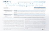 Prótesis mitral mecánica disfuncionante evaluada mediante …video.grupocto.com/videosEspecialidades/Revista... · 2017-04-18 · 37 • Casos clínicos caso 05 RETIC 2017; 4: 35-38