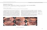 Imagen del mes Hemorragia digestiva baja en paciente con ...gastrolat.org/DOI/PDF/10.0716/gastrolat2018n2000.05.pdf · trombofilia adquirida en control por hematología. En 2012 es