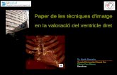 Paper de les tècniques d'imatge en la valoració del ...€¦ · Anomalía parcial del retorno venoso pulmonar sup derecho VCS VPSD AD TP TP ... •Es sin duda la prueba de 2da línea