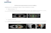 Radioterapia Estereotáctica Corporal (SBRT) ... 4. Wolf A, Kondziolka D: Brain metastases: radiosurgery. Handb Clin Neurol 149:129-135, 2018 5. Soike MH, Hughes RT, Farri s M, et