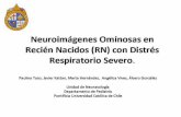 Diapositiva 1manuelosses.cl/BNN/neuroimagenesominosasensdrsevero.pdf · 2011. 4. 17. · En 4/5 RN evolucionaron con lesiones hemorrágicas y en I, en zonas asociadas habitualmente