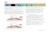 Vocabulario util lCo - LASIK...Un implante de drenaje es un dispositivo pequeno colocado en el ojo para tratar el glaucoma. Cuando una persona tiene glaucoma, el humor acuoso no drena