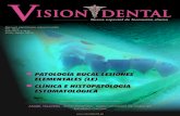 PATOLOGÍA BUCAL LESIONES ELEMENTALES (LE) CLÍNICA E … Cientificos/Ciencia05.pdf · 2020. 8. 28. · REVISTA VISION DENTAL Vi. dent. 2019; 25 03 Nuevo especial de formación clínica