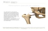 Reemplazo parcial de cadera - Instituto Penta de ... Reemplazo parcial de cadera Un reemplazo parcial